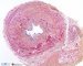 Parietal fibrosis in ureteropelvic junction obstruction