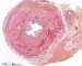 Parietal fibrosis in ureteropelvic junction obstruction
