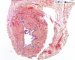 Parietal fibrosis in ureteropelvic junction obstruction