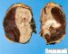 Renal subcapsular hemorrhage in Wilms tumor