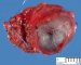 Thyroid follicular adenoma