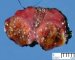 Thyroid follicular adenoma