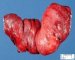 Thyroid papillary carcinoma