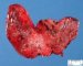 Thyroid papillary carcinoma