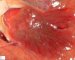 renal Wegener granulomatosis