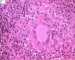 Langhans cell in tuberculoid granuloma