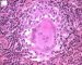 Langhans cell in tuberculoid granuloma