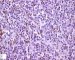 CD15 in mixed cellularity Hodgkin lymphoma