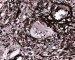Nodal cryptococcosis (Cryptococcus neoformans)