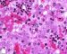 Parvoviral inclusion in fetal liver (hydrops fetalis)