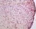 post-chemotherapy embryonal rhabdomyosarcoma