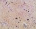 post-chemotherapy embryonal rhabdomyosarcoma