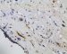 post-chemotherapy embryonal rhabdomyosarcoma