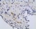 post-chemotherapy embryonal rhabdomyosarcoma