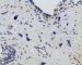 post-chemotherapy embryonal rhabdomyosarcoma