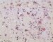 post-chemotherapy embryonal rhabdomyosarcoma