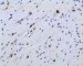 post-chemotherapy embryonal rhabdomyosarcoma