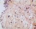 post-chemotherapy embryonal rhabdomyosarcoma