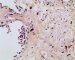 post-chemotherapy embryonal rhabdomyosarcoma