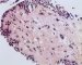 post-chemotherapy embryonal rhabdomyosarcoma
