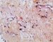 post-chemotherapy embryonal rhabdomyosarcoma