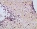 post-chemotherapy embryonal rhabdomyosarcoma
