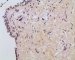 post-chemotherapy embryonal rhabdomyosarcoma