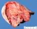 Sacrococcygeal teratoma