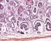 Renal tubular dysgenesis