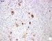 CD15 in classic Hodgkin lymphoma