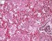 Acute alveolitis in acute baterial pneumonia