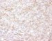 ALK immunolabelling in myofibroblastic inflammatory tumor