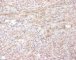ALK immunolabelling in myofibroblastic inflammatory tumor