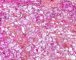 Cardiac rhabdomyoma