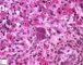 Nuclear and cytoplasmic inclusions in CMV fetopathy
