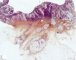 Colonic adenocarcinoma