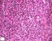 Acute inflammation with granulocytic diapedesis in ileal Crohn (...)