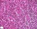 Acute inflammation with granulocytic diapedesis in ileal Crohn (...)