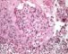 Cutaneous leishmaniasis