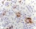 Vulvar embryonal rhabdomyosarcoma
