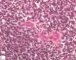 Vulvar embryonal rhabdomyosarcoma