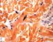Epidermal nevus with melanocytosis