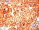 Epidermal nevus with melanocytosis