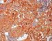 Epidermal nevus with melanocytosis