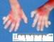 Hand post-axial polydactyly
