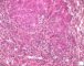 Massive hepatic necrosis in fulminant auto-immune hepatitis
