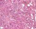 Massive hepatic necrosis in fulminant auto-immune hepatitis