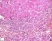 Massive hepatic necrosis in fulminant auto-immune hepatitis