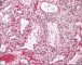 Hyaline membrane disease
