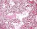 Hyaline membrane disease